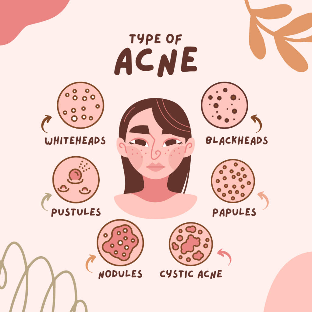 An assortment of homemade ingredients for DIY acne treatments, including tomatoes, oatmeal, bananas, and lemons.




