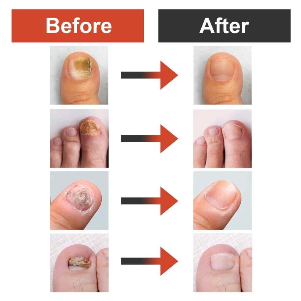 Before and After Image on how to Cure toe Nail Fungus